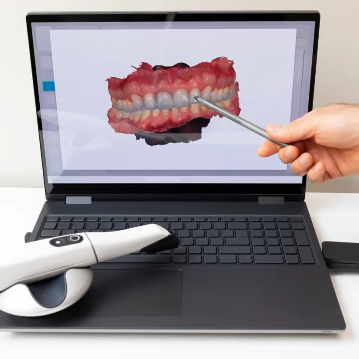 A 3D scan of a patient's gums and teeth on a laptop beside the scanner wand
