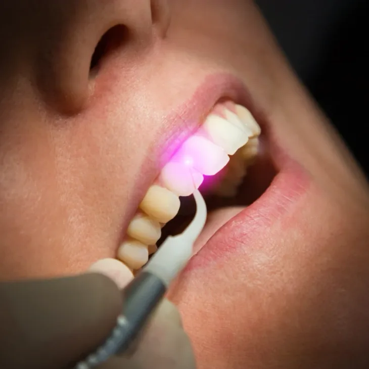 A dental laser treating a patient's gum line