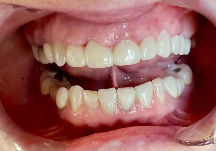 After photo of the same patient's smile